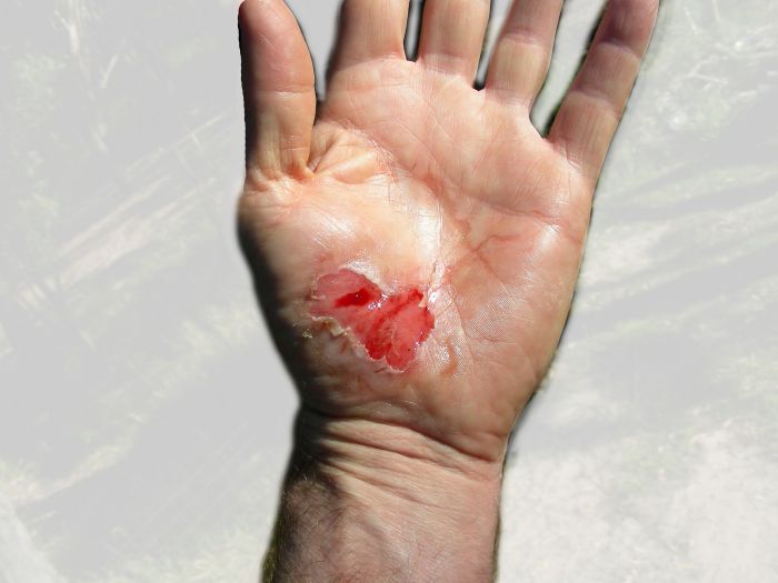 Cut on hand